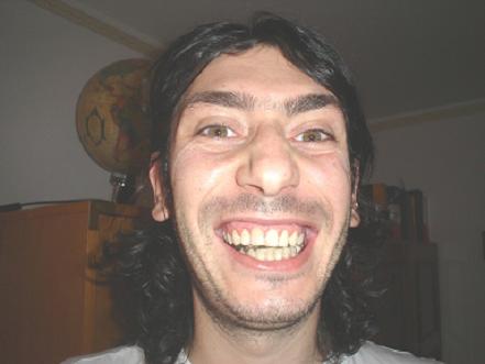 con bite muscolatura in tensione.JPG